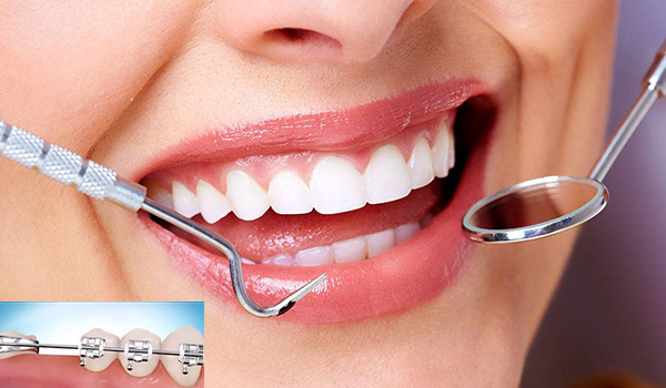 میکرو اسکرو یک ابزار و متد ارتودنسی جدید ارتودنسی لینگوال، از جدیدترین مدل های ارتودنسی