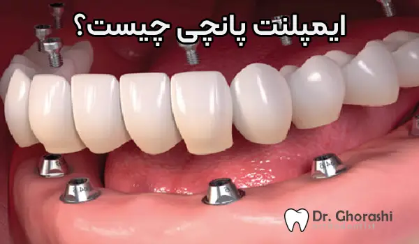 ایمپلنت پانچی چیست کلینیک دکتر سعید قریشی