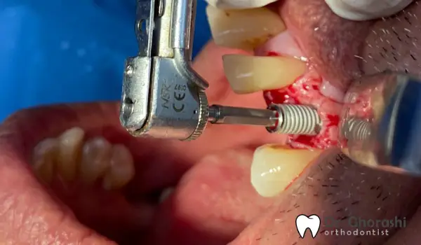 ایمپلنت پانچی چیست