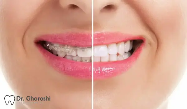 بلیچینگ در خانه بعد از ارتودنسی