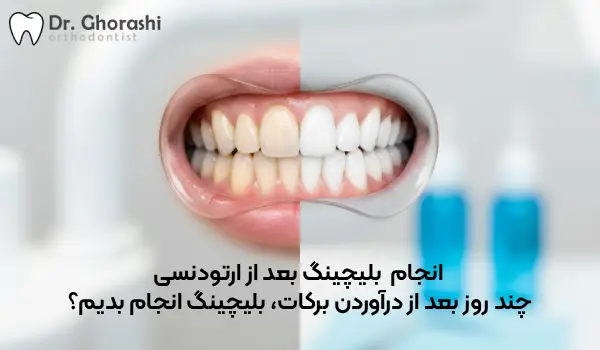 بلیچینگ بعد از ارتودنسی