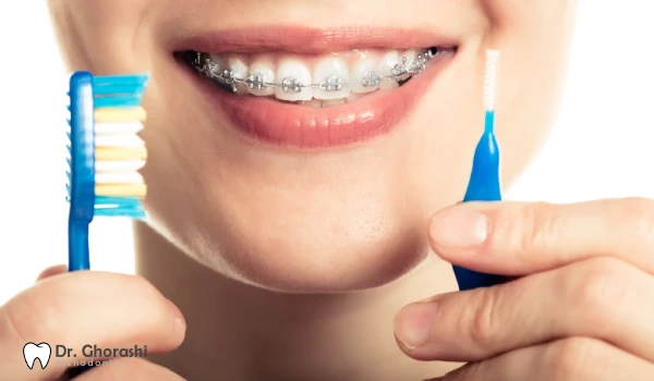 نحوه تمیز کردن ریتینر ارتودنسی