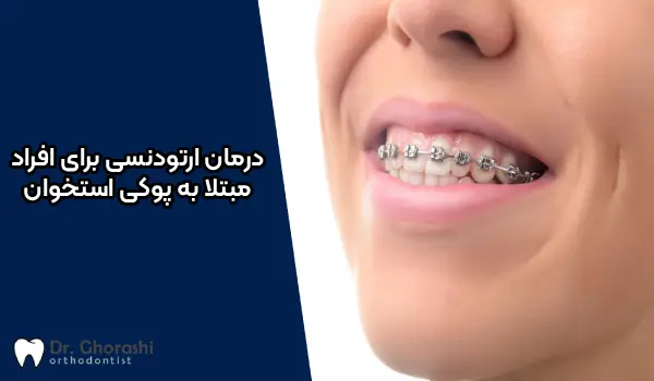 درمان ارتودنسی برای افراد مبتلا به پوکی استخوان کلینیک دکتر سعید قریشی