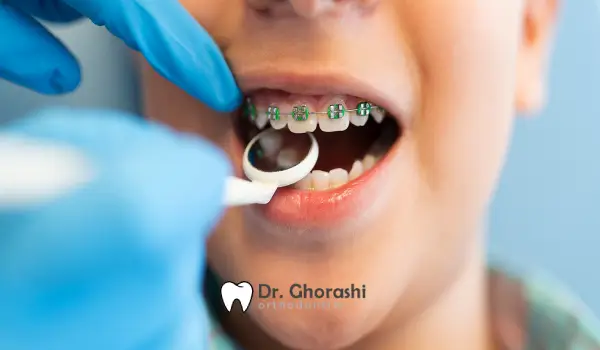 شایعات درباره ارتودنسی