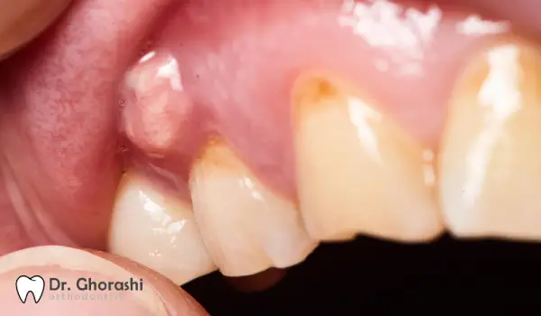 عفونت دندان حین ارتودنسی کلینیک دکتر سعید قریشی