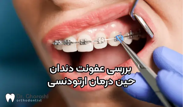 عفونت دندان حین ارتودنسی