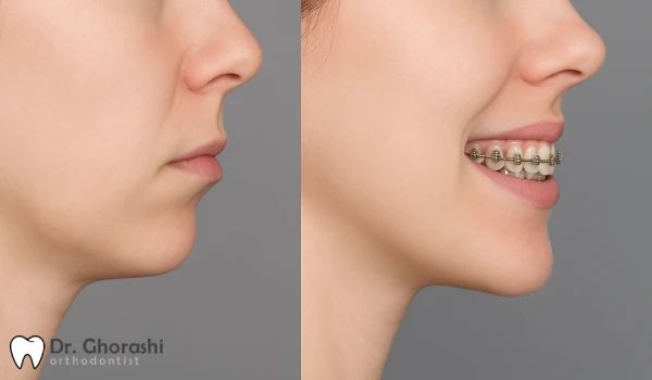 ارتودنسی یا ژینوپلاستی