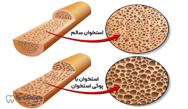 درمان ارتودنسی برای افراد مبتلا به پوکی استخوان کلینیک دکتر سعید قریشی