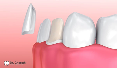 ارتودنسی برای دندان لمینت شده امکانپذیر است؟