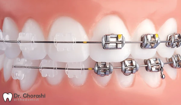 حساسیت به بریس ارتودنسی