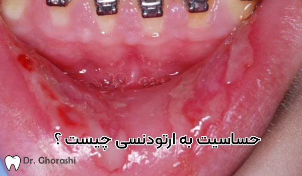 حساسیت به بریس ارتودنسی